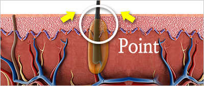 hair transplant double check technique