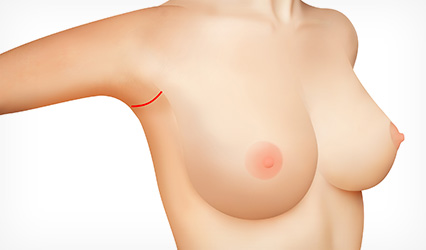 An incision made in the deepest part of the armpit fold  