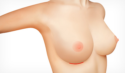 Incision made invisible in the crease below the breast
