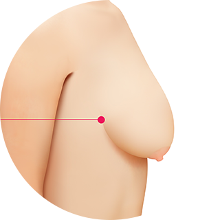 ID Plastic Surgery Hospital Korea - 🤔 Concerned about saggy breasts? 🤭  Breast lifting can change saggy breasts to firm breasts by removing fat,  breast tissue and excess skin. . . ☎