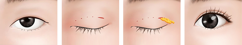 작은 눈 두툼한 피부 수술방법1