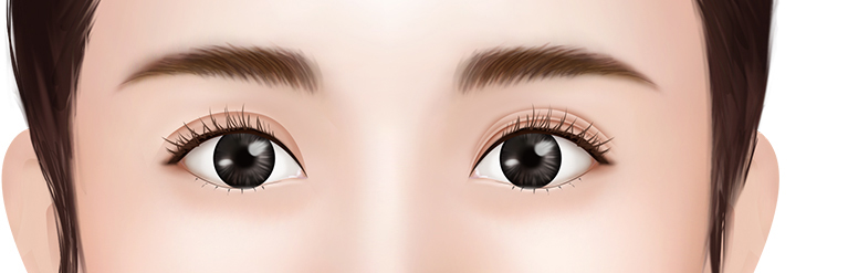 Asymmetrical Double Eyelids