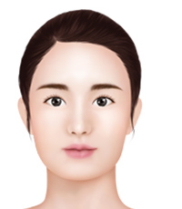 Mini V-Line – Front Jaw Reduction Surgery