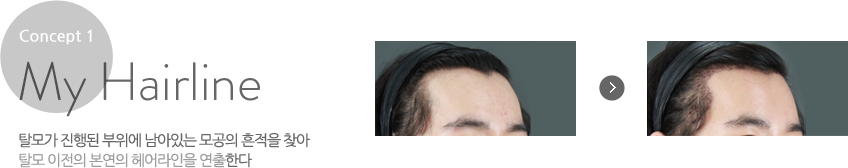 My Hairline:탈모가 진행된 부위에 남아있는 모공의 흔적을 찾아 탈모 이전의 본연의 헤어라인을 연출한다