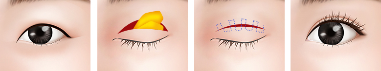 小さな目、分厚い皮膚 手術方法2