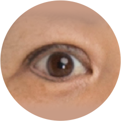 Неестественный вид глаз после блефаропластики.