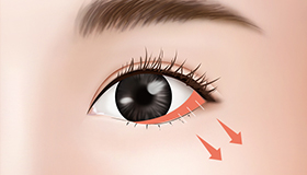 Make a fine incision of the lower end of the eye corner and pull it down at a natural angle to secure it firmly
